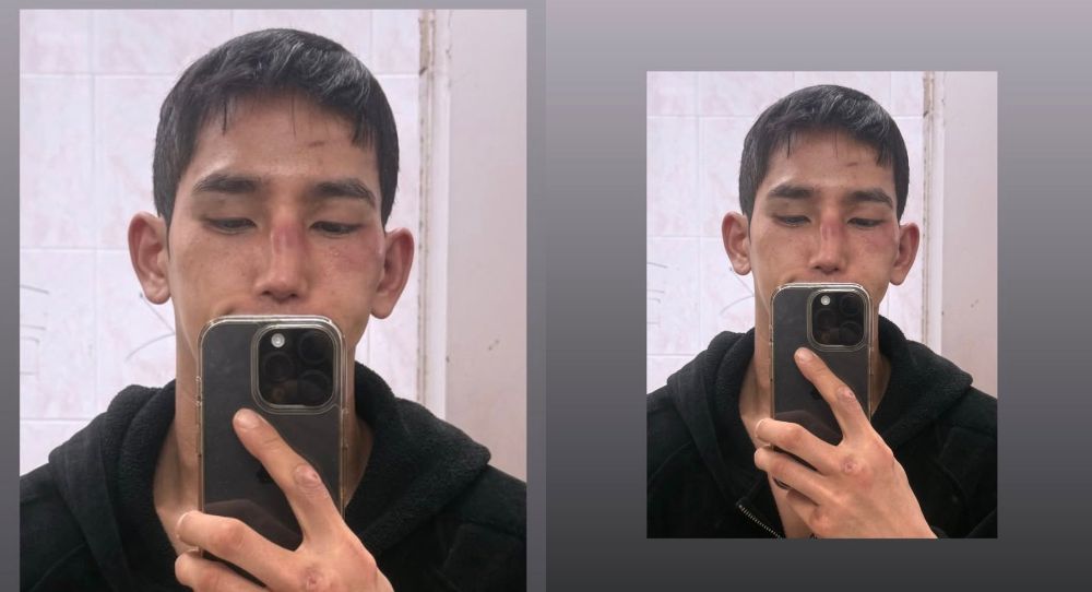 Single’s Inferno 4 star Yoo Jun Seo says he needs surgery after nose fracture, eardrum rupture and elbow injury